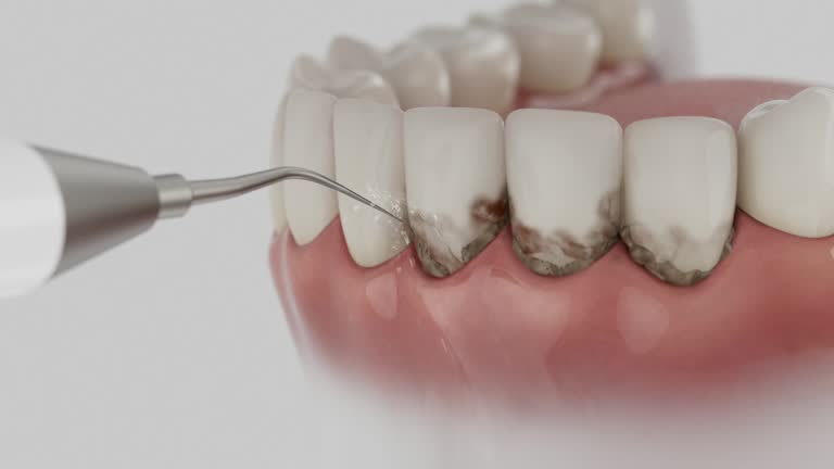 Reliable Dental Implants contractor in Moberly, MO by Smile Center Dentistry